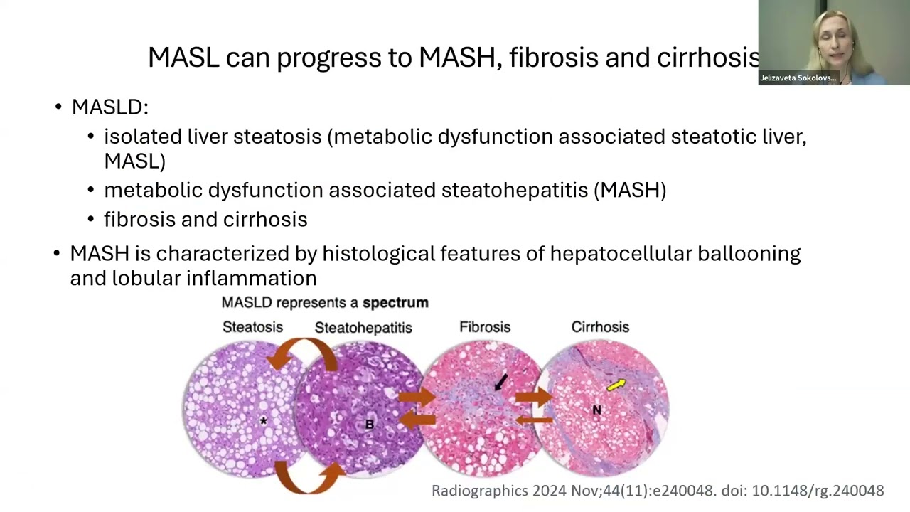 Spotlight on Science-Metabolic dysfunction associated steatotic liver disease -Jelizaveta Sokolovska