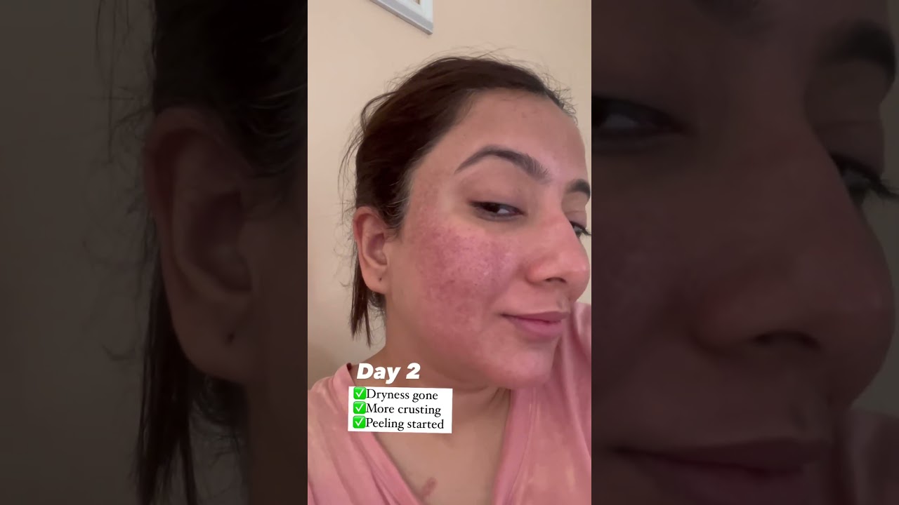 laser treatment for open pores!   #youtubeshorts #shots #influennz #laser #aesthetic #skincare