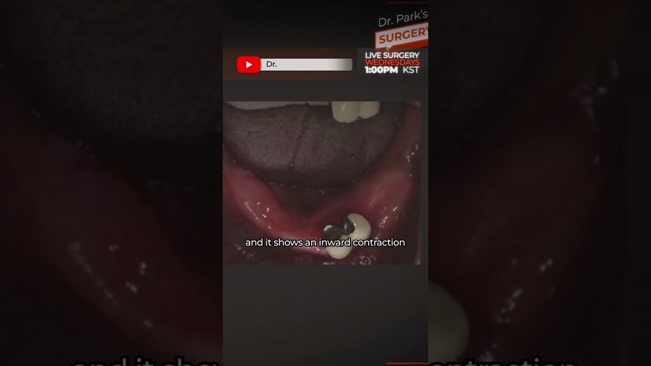 Mandible Full Mouth Guided Surgery with R2Gate🖥️ #R2Gate #digitaldentisty
