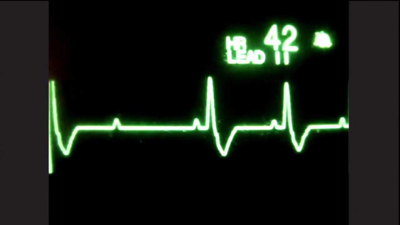 Second Degree AV Block, Type II - ACLS Rhythm Recognition and Guidelines