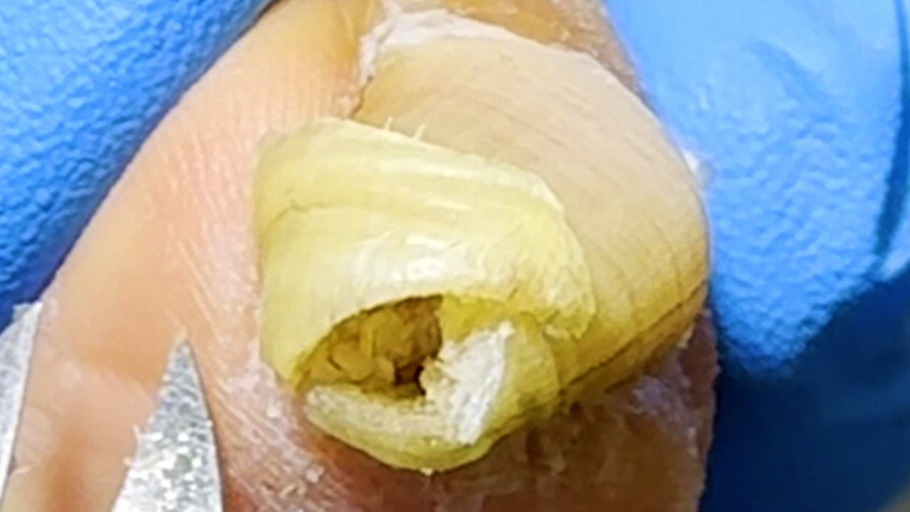 Long And Curly! The Patient Has Not Had A Pedicure For 4 Months【Xue Yidao】