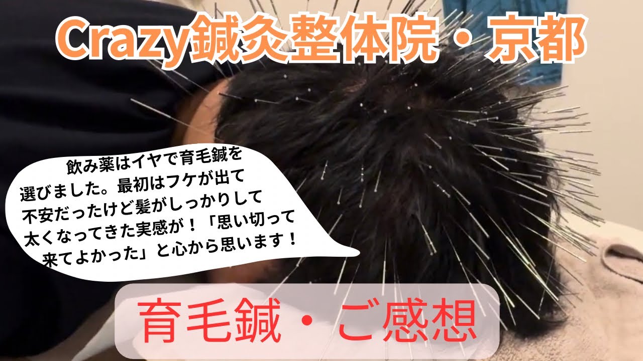 【薄毛治療の新常識】飲み薬が苦手で「育毛鍼」を選んだ私のリアル体験談｜Crazy鍼灸整体院