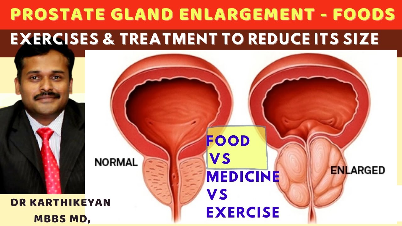 [ENGLISH] prostate gland & urinary problems, exercise for enlarged prostate treatment|dr karthikeyan