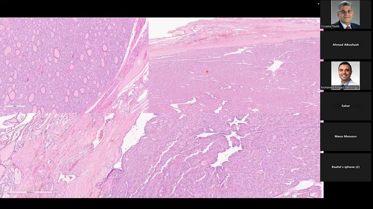 Thyroid Follicular-Patterned Neoplasms: WHO Updates and Diagnostic:  Mena Mansour, MD | MD Anderson