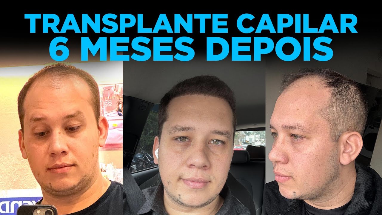 6 MESES DE TRANSPLANTE CAPILAR 5 MIL FOLÍCULOS - 6th hair transplant 5k grafts