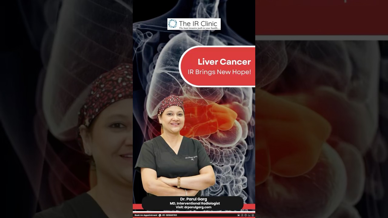 🌟 Liver Cancer Treatment with #interventionalradiology | Dr. Parul Garg Explains New Hope