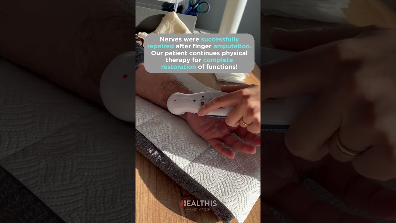 Nerve repair after finger amputation