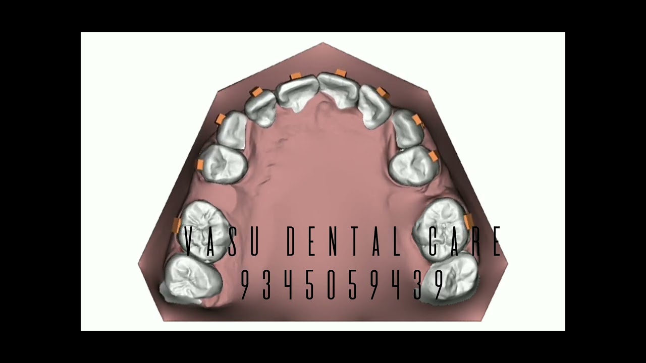 Invisible braces 