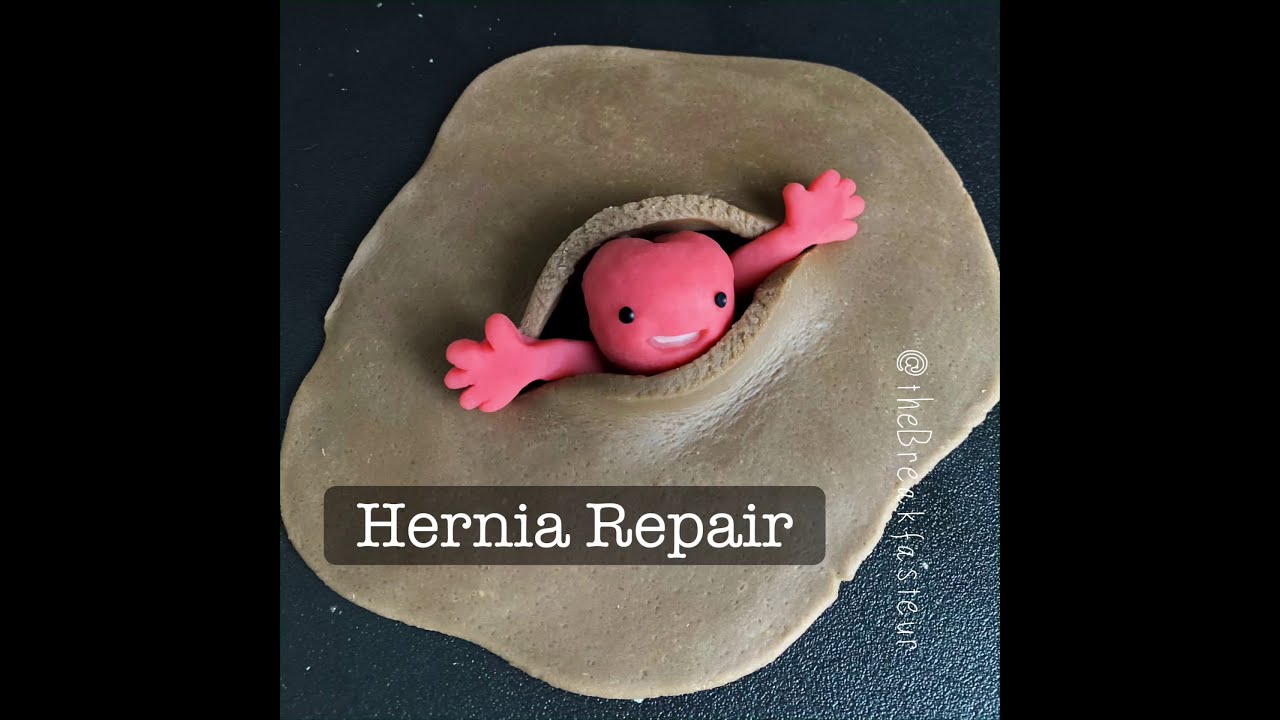 Playdough Surgery 🔪🗣- Open Inguinal Hernia Repair (Lichtenstein tension-free mesh repair)