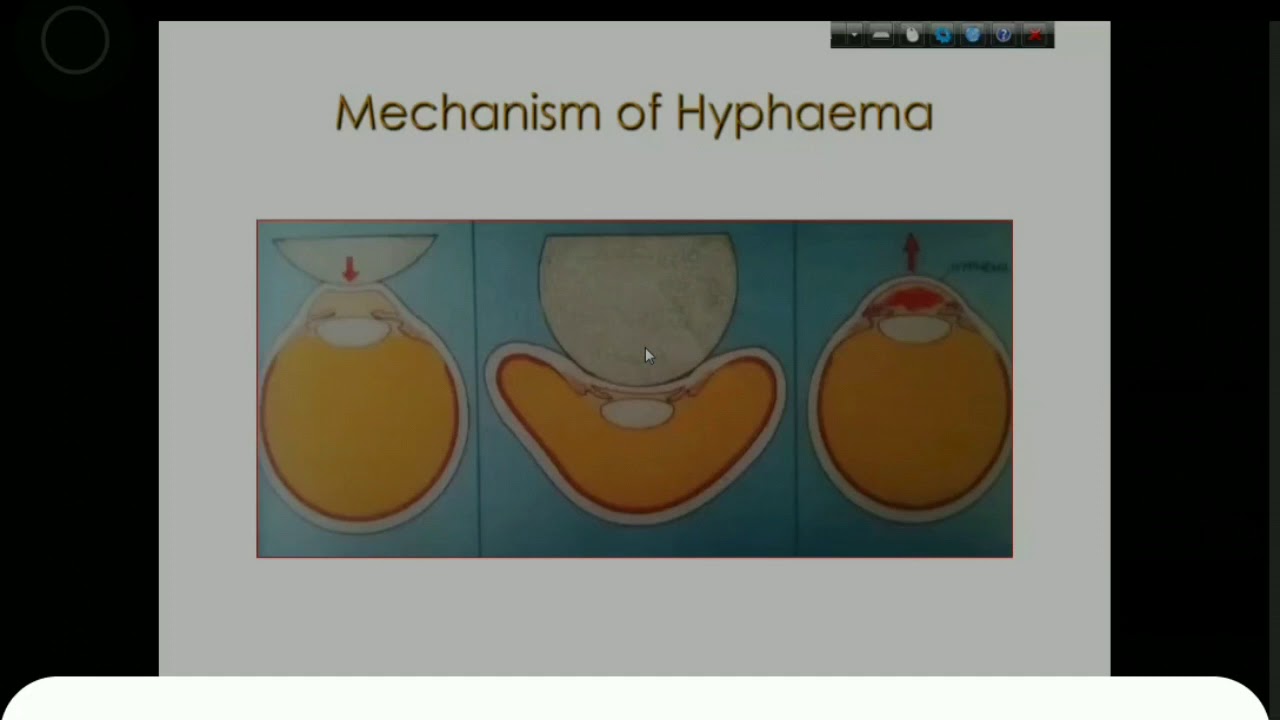 OPHTHALMOLOGY : HYPHAEMA BY PROF. A. QUADER