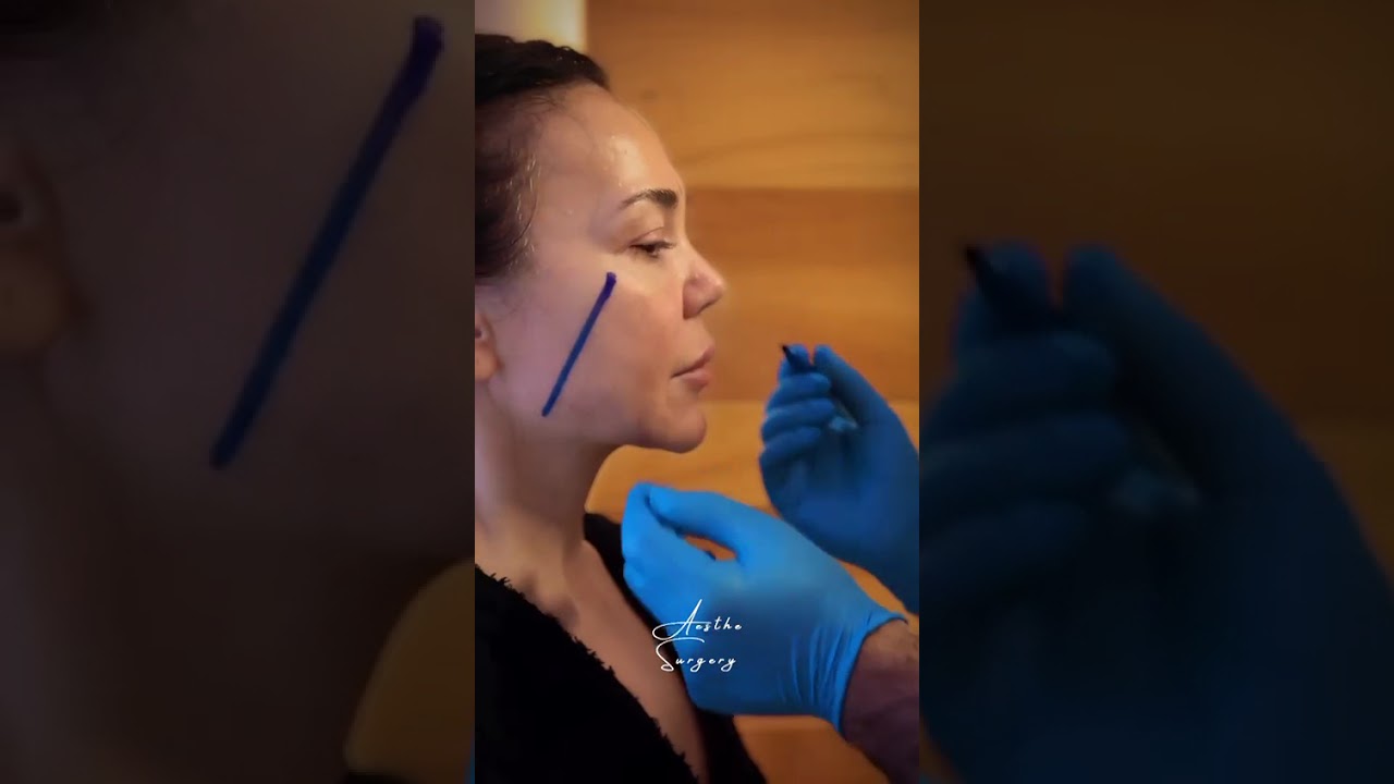 Preoperative Marking  | Dr. Berat Oyur &ndash; Aesthe Surgery