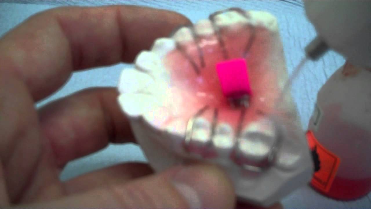Maxillary Expansion orthodontic appliance - learn how to add the screw and lay the baseplate.