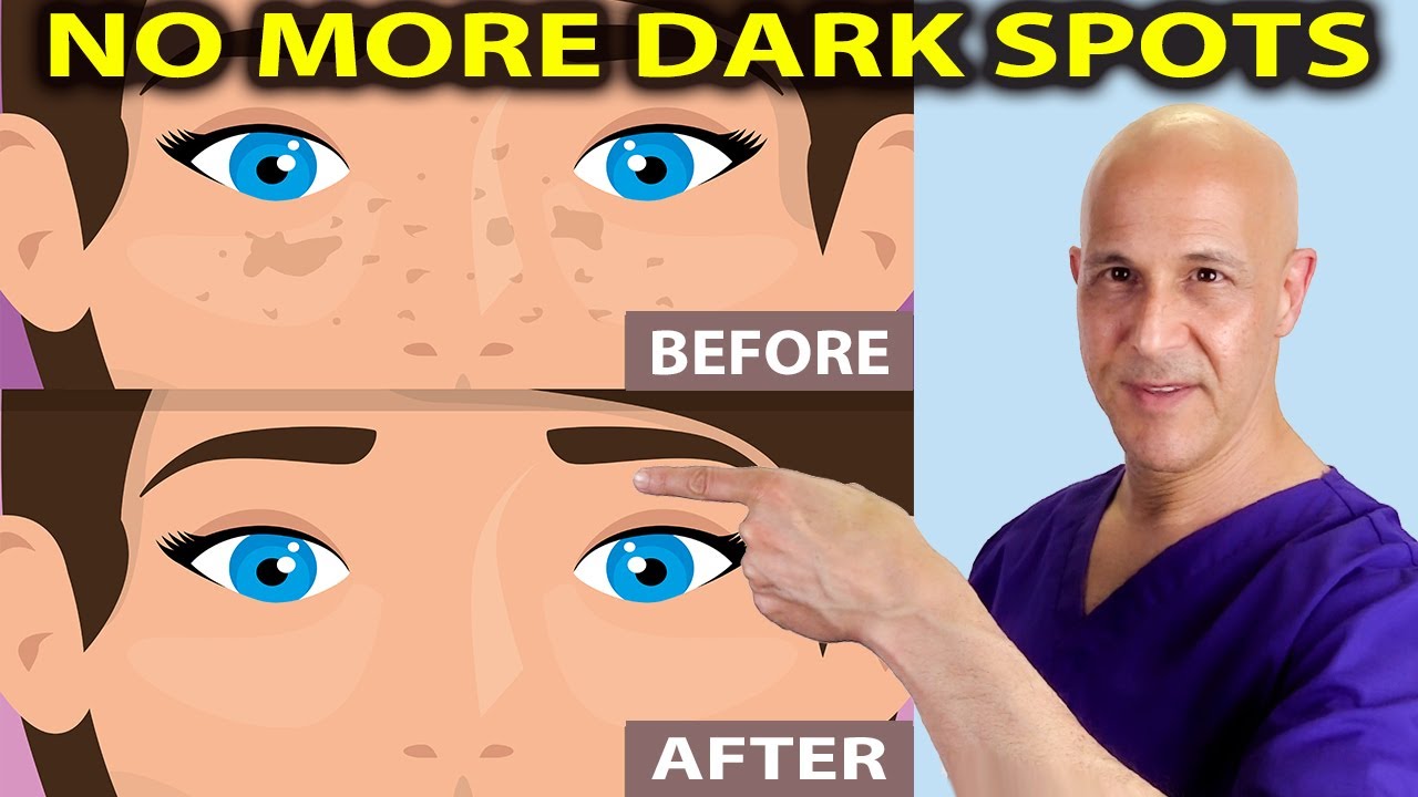 Brighten Your Skin:  How to Lighten Dark Spots with Everyday Ingredients!  Dr. Mandell