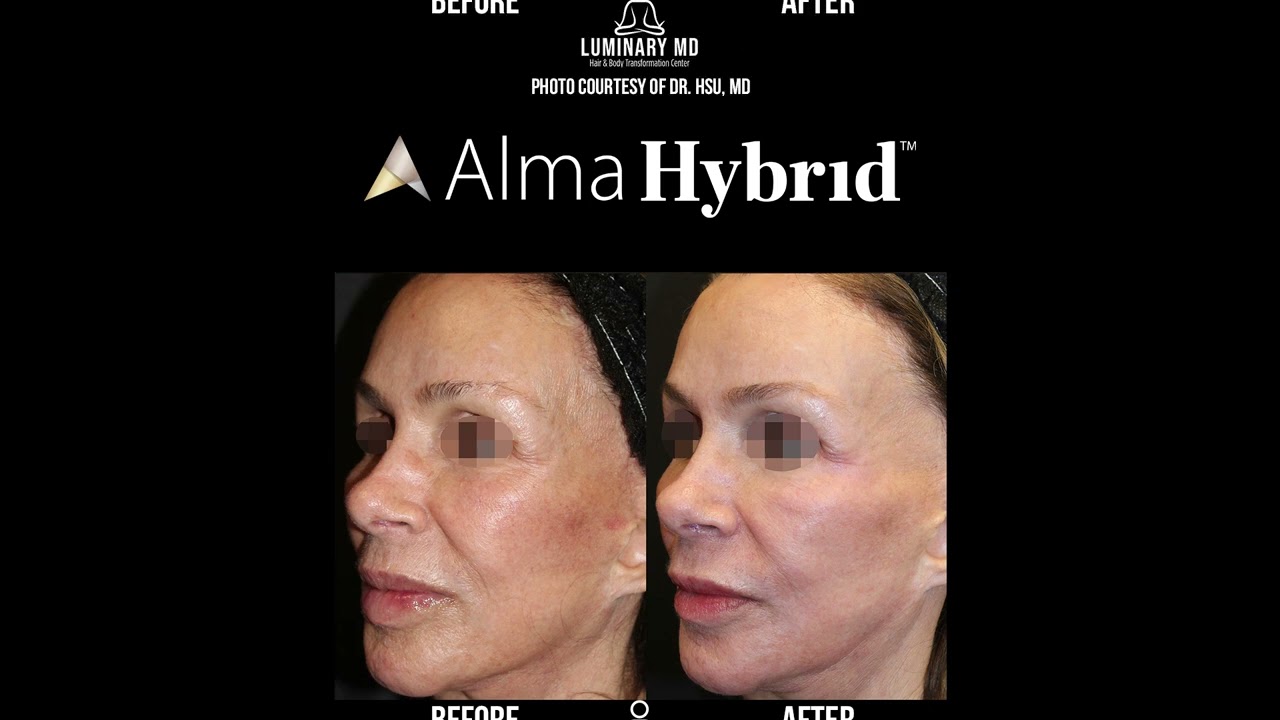 Alma Hybrid CO2 Laser Before & After Results | Skin Rejuvenation, Scars & More | Dr. Milanes MD