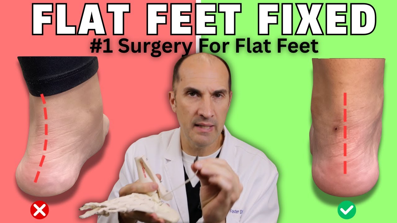 Why EOTTS is the #1 Surgery for Flat Feet