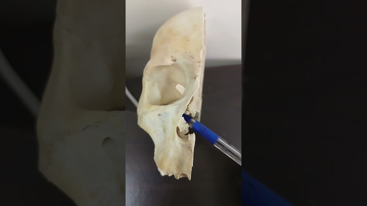 Maxillary sinus