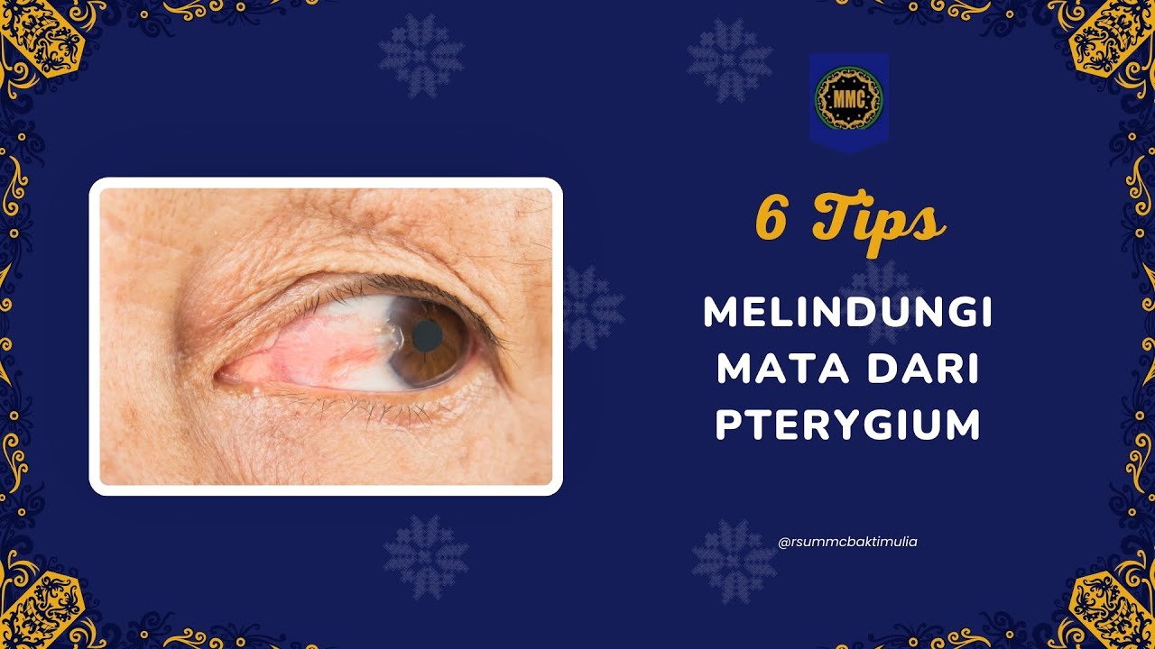 6 Tips Melindungi Mata dari Pterygium 