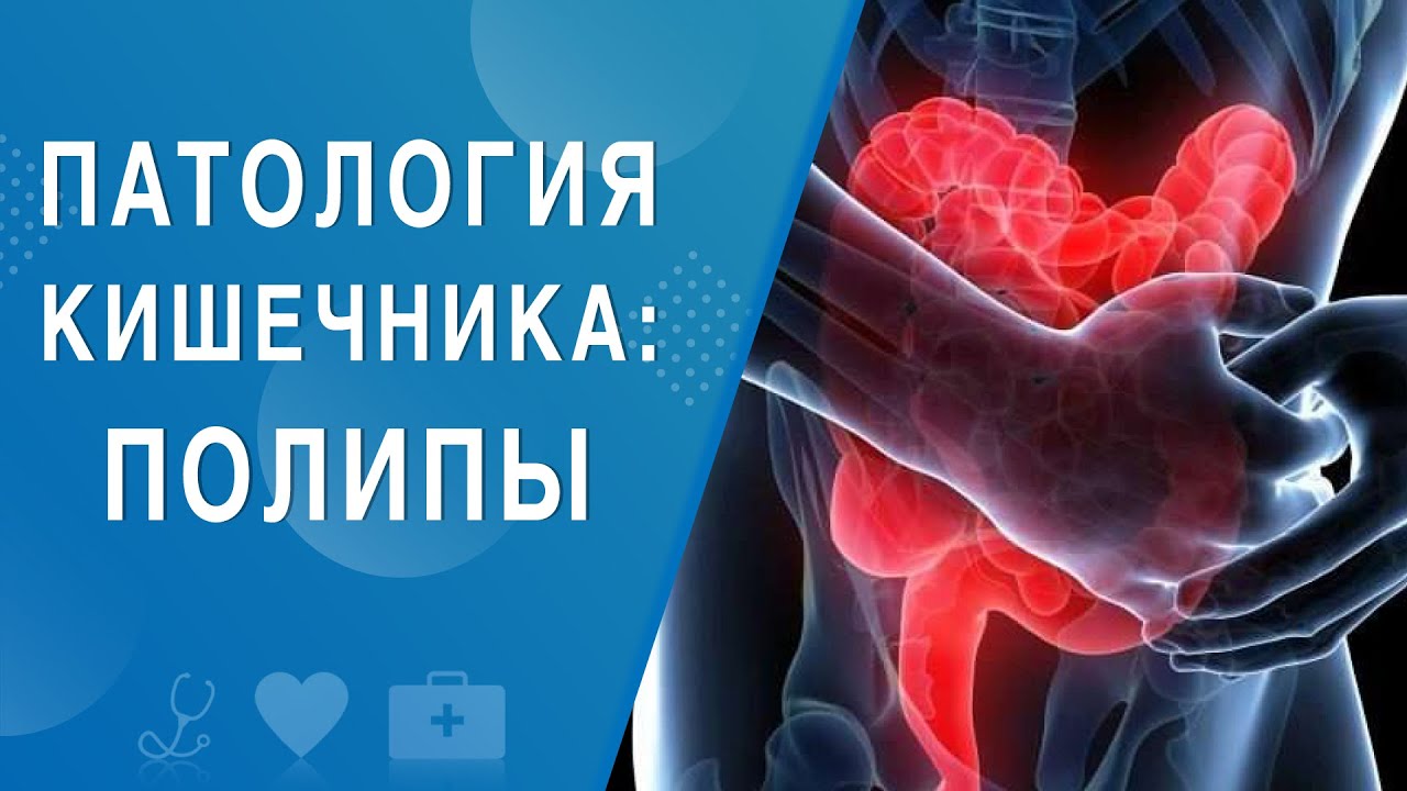 Патология кишечника: полипы. На здоровье 03.10.2020