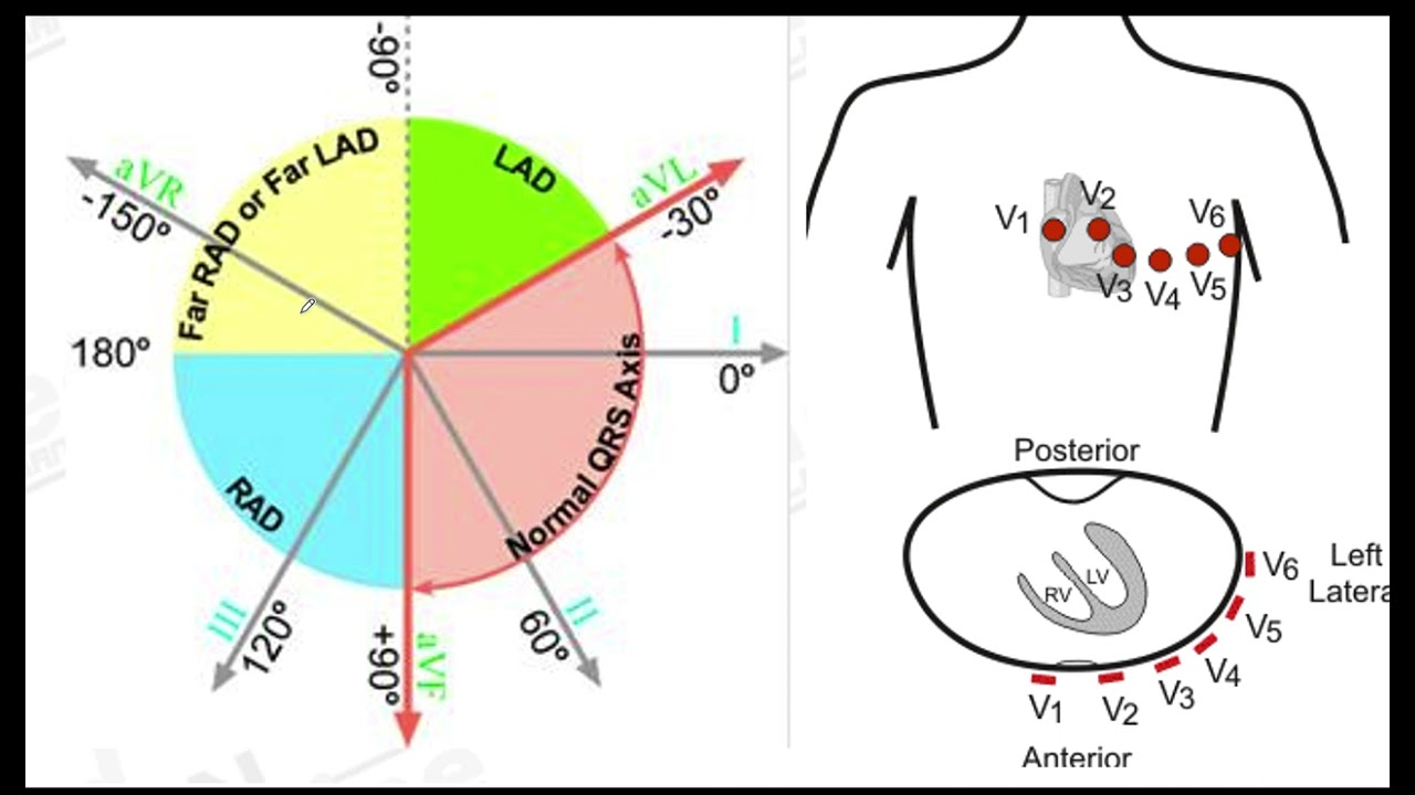 Infarto Cara Posterior del Ventriculo Izzquierdo