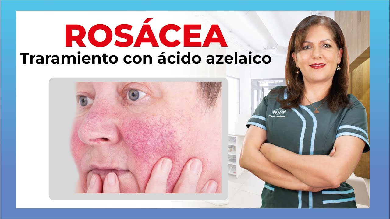 Como tratar la ROSÁCEA, mejora la piel de tu rostros con acido azelaico - protocolo practico