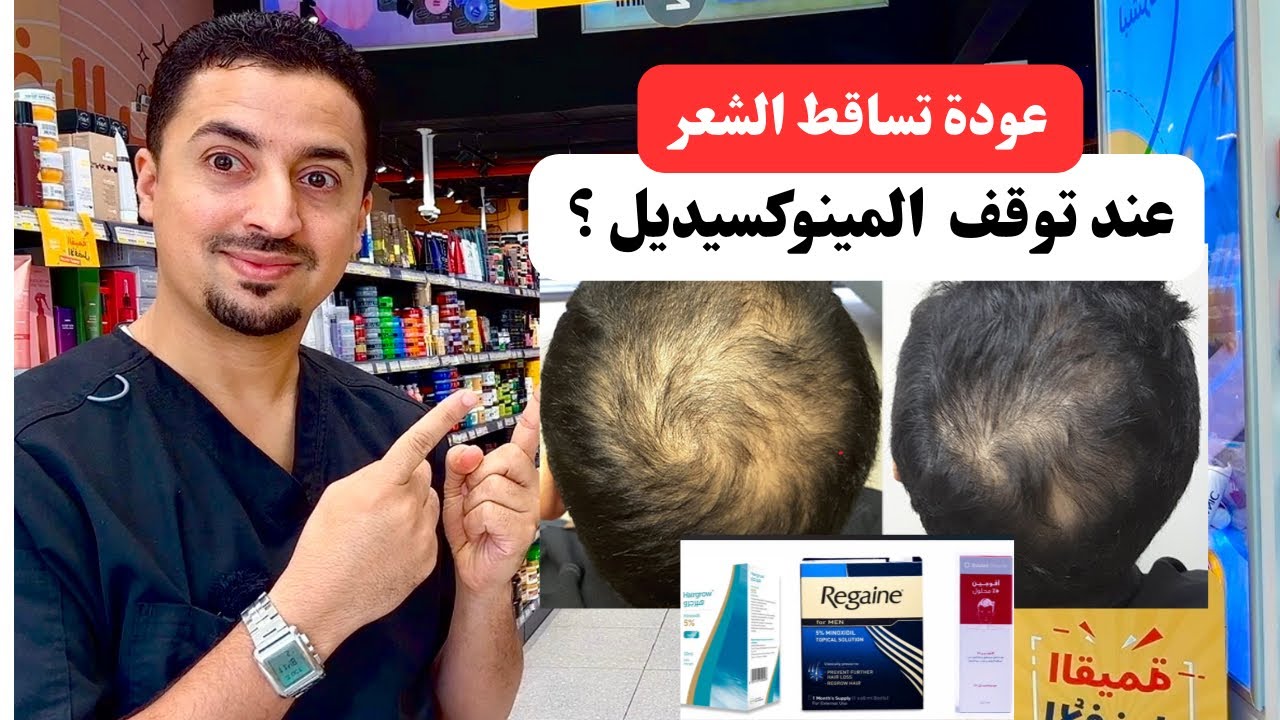 هل سيتساقط شعرك بعد إيقاف المينوكسيديل؟ اكتشف الأسباب والحلول!