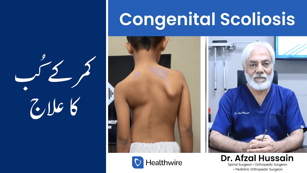 Congenital Scoliosis Treatment - Kamar ka Tedha Pan - Kamar ka Kub - Wajoohat aur Ilaaj!