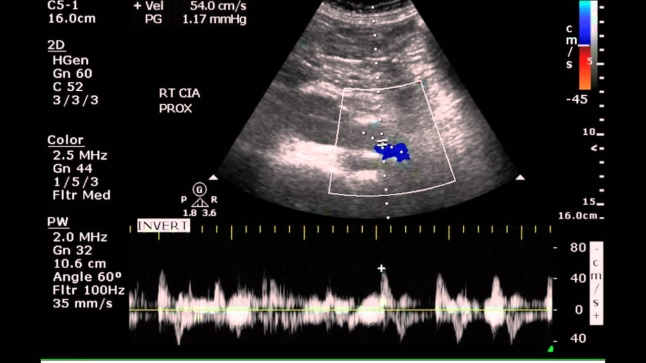 Duplex Examination of an Aortic Aneurysm - Case Study