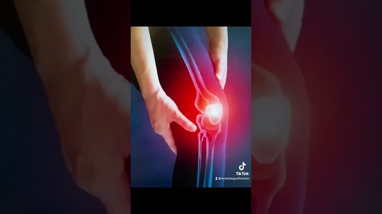Genou 🦴 douloureux Ligament Crois&eacute; Ski ⛷️ & Surf 🏄&zwj;♂️ : r&ocirc;le du radiologue 🥼 IRM 🩻 Radio Scanner