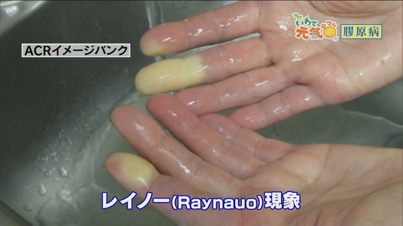 いわて元気○　【膠原病（こうげんびょう）】（2016/7/28放送　ニュースプラス１いわて）