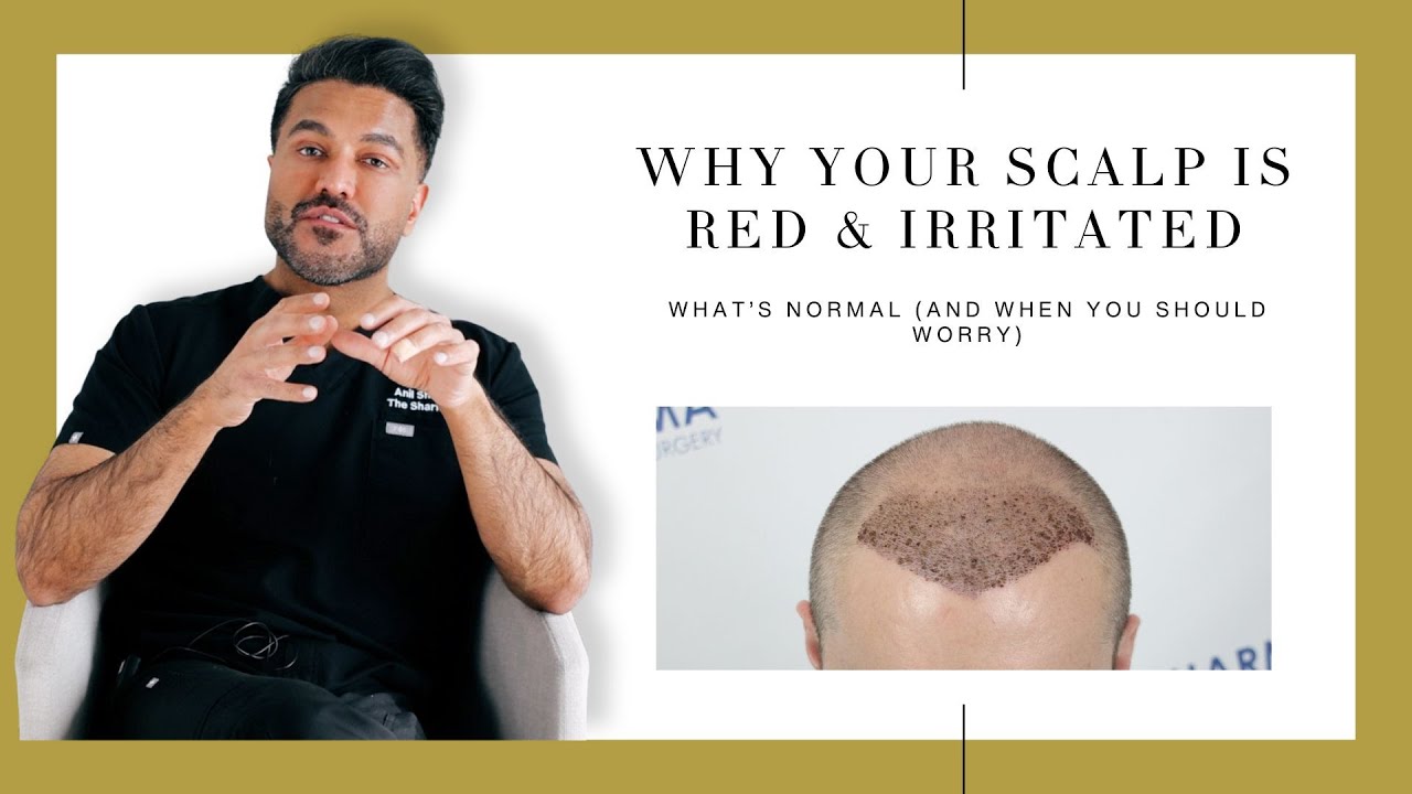 Redness & Swelling After A Hair Transplant? (And What's Our Hair Transplant Aftercare Protocol?)