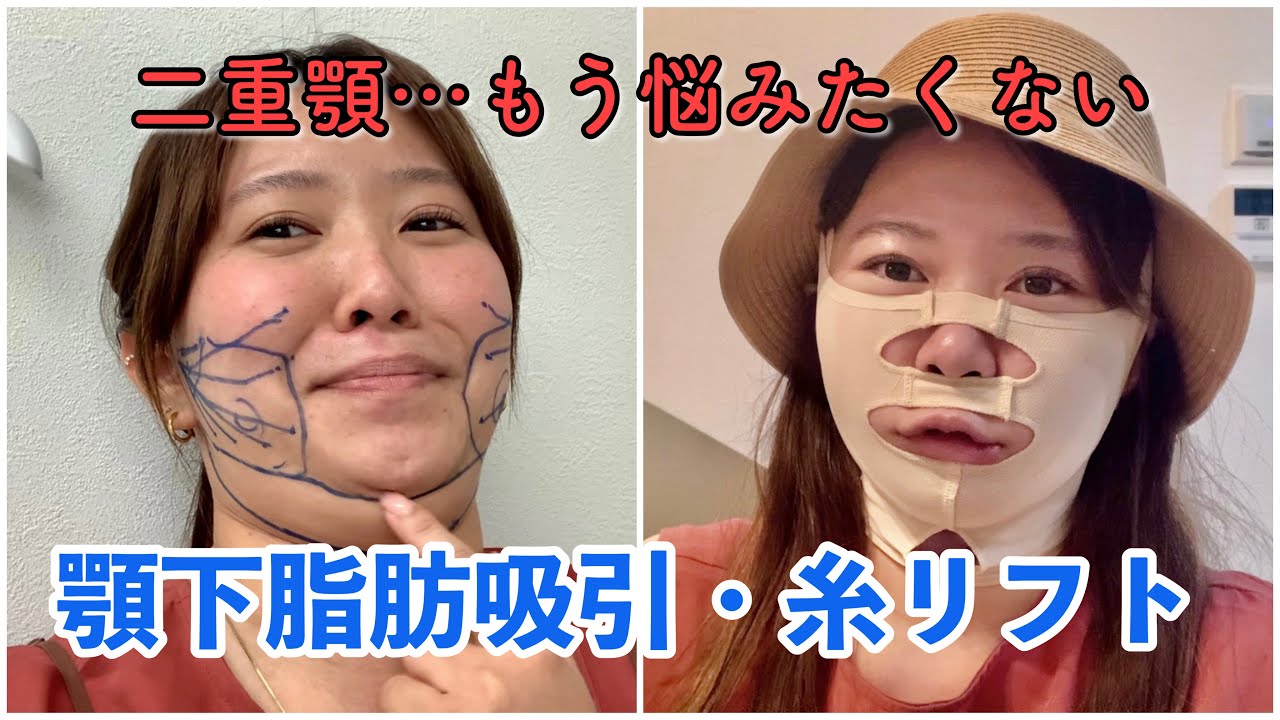 長年悩んだ二重顎😢【顎下脂肪吸引・糸リフト】を受けて1ヶ月☝️