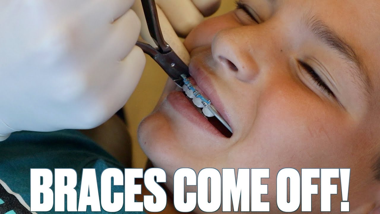 GETTING BRACES OFF FOR THE FIRST TIME | BRACES REMOVED | TAKING BRACES OFF | BEFORE AND AFTER BRACES