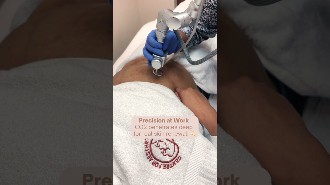 Old Burn Scar Treatment by CO2 Laser Treatment 