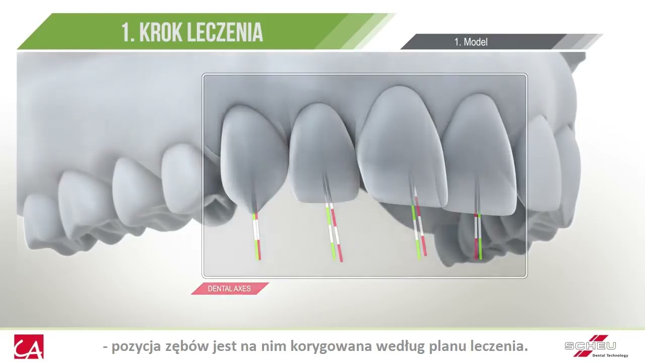 Leczenie nakładkami Clear Aligner | Ortodent Rzeszów