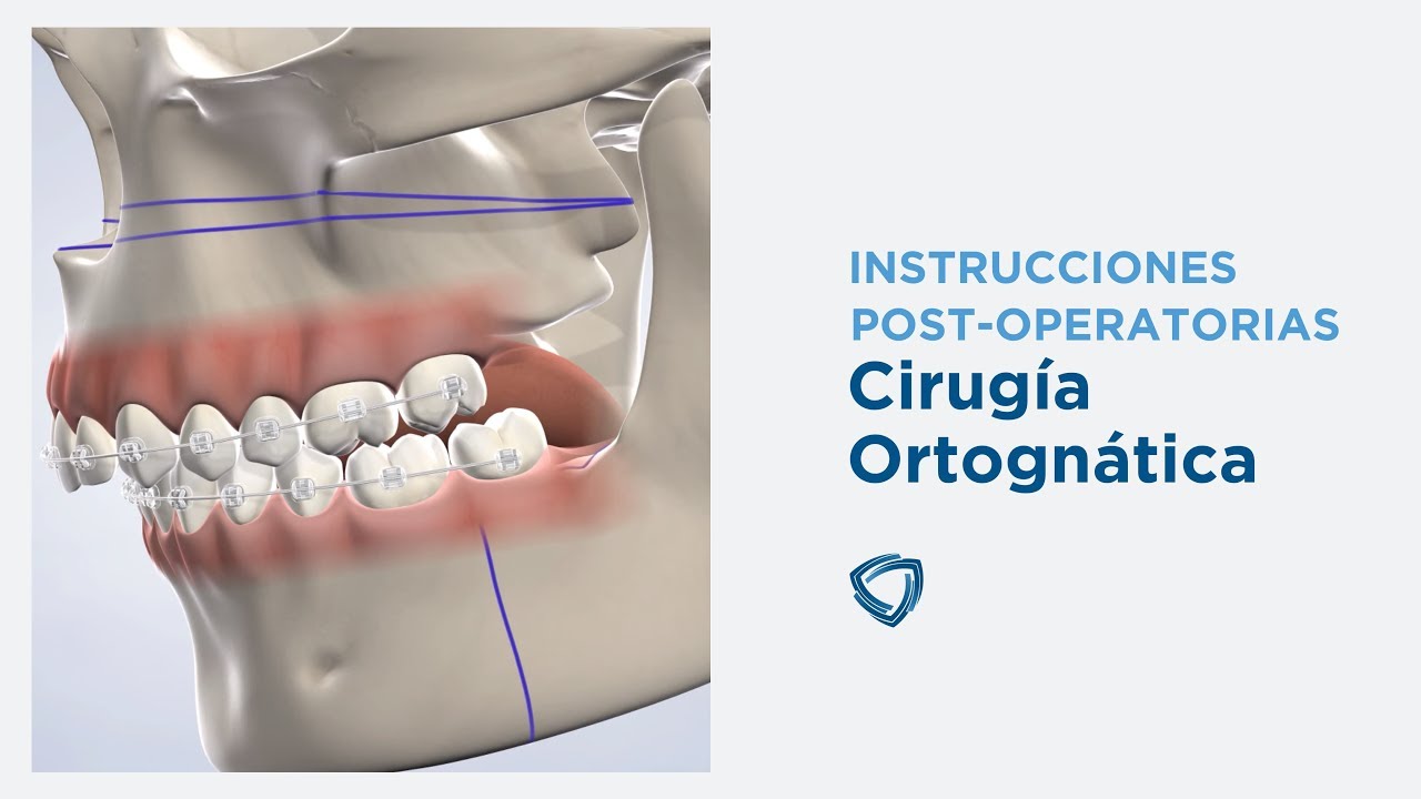 Instrucciones Postoperatorias: Cirugía Ortognática | Columbia Basin Oral & Maxillofacial Surgeons