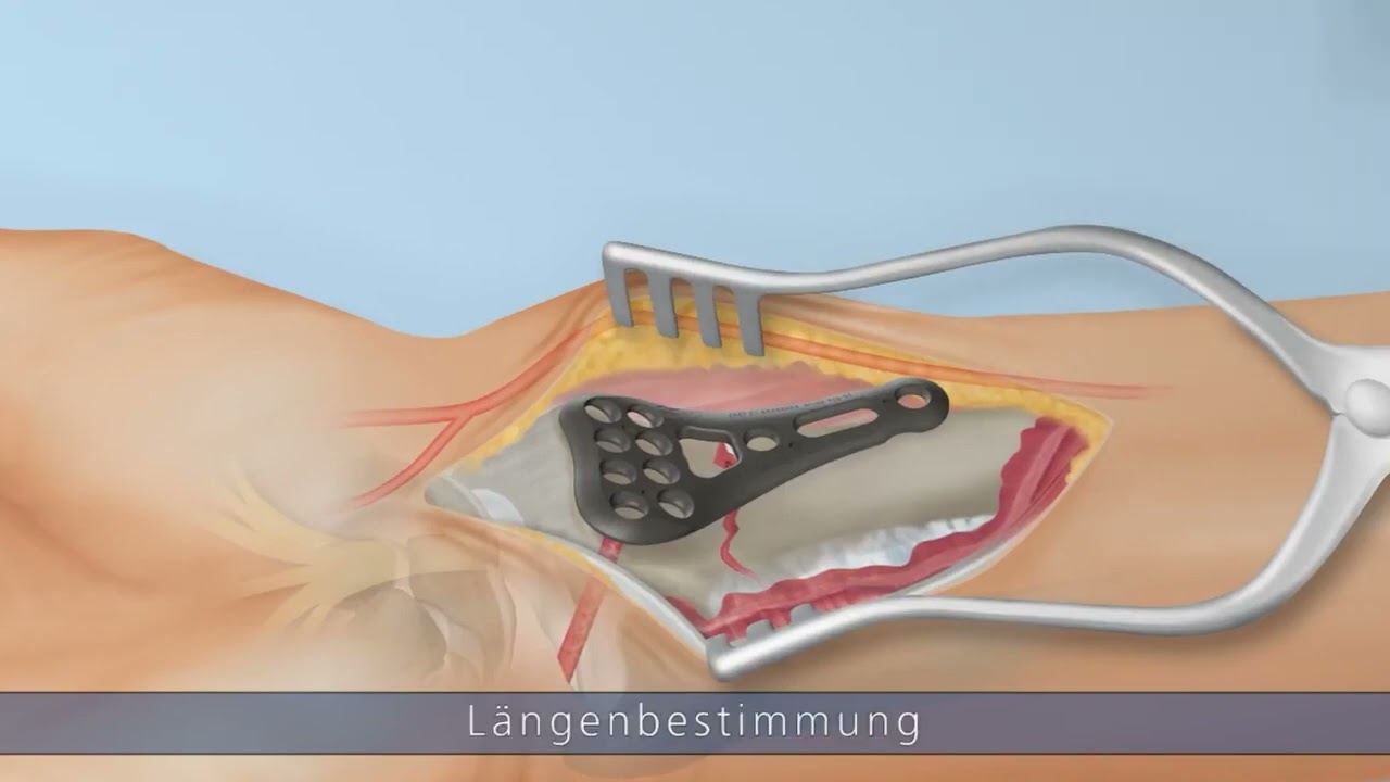 Ixos&reg; Radiusplattensystem P4 Wave &ndash; OP Technik