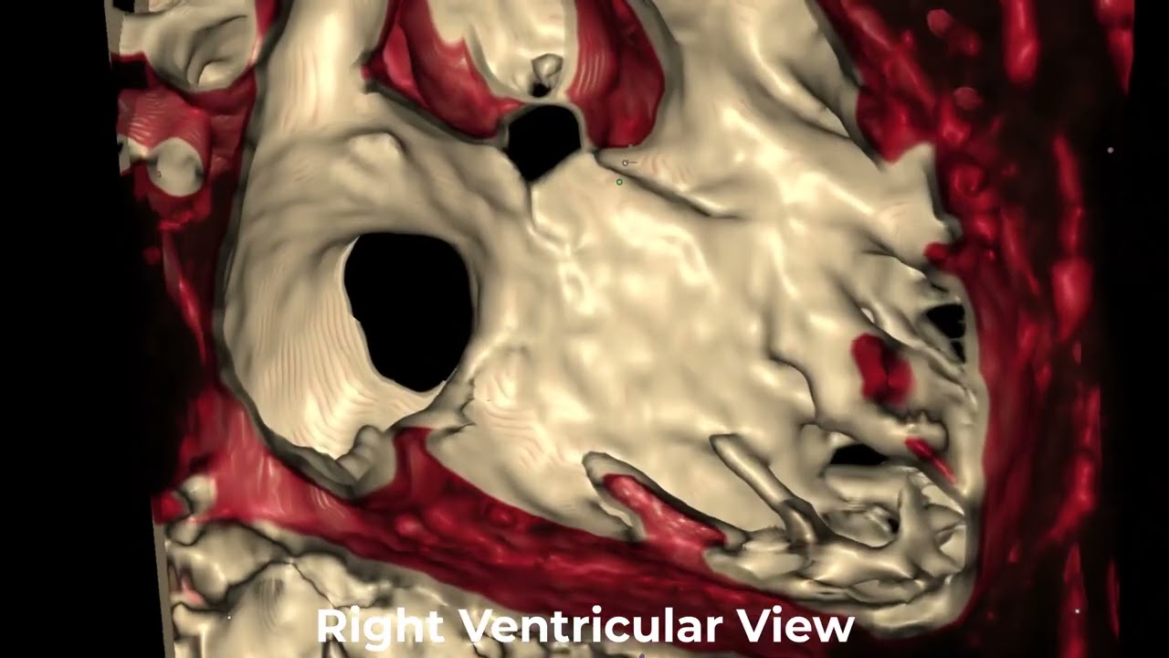 3D Slicer Volume Rendering and Virtual Device Placement for Multiple Ventricular Septal Defects