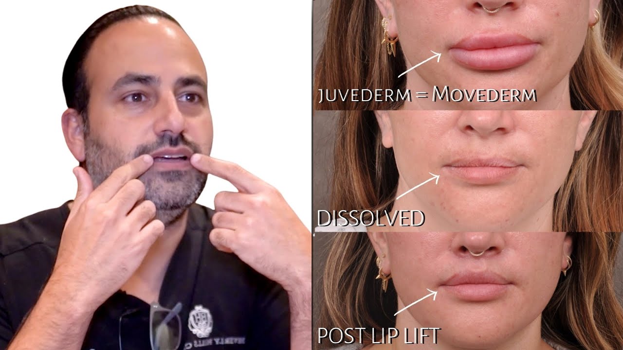 Weekend Neck Lift and Lip Restoration using Lip Lift