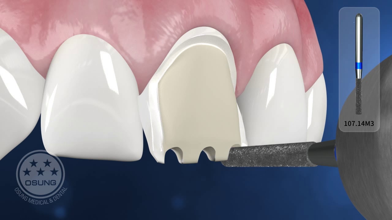Metal ceramic restoration anterior teeth