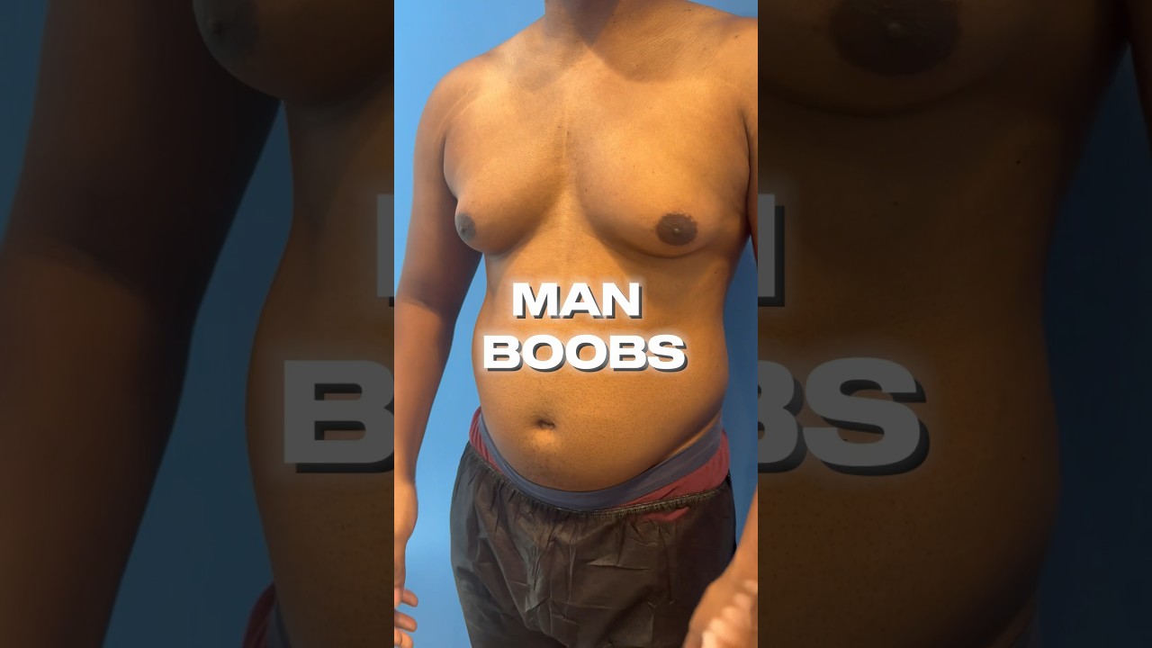 Gynecomastia, also known as &ldquo;man boobs&rdquo;, affects men by overgrowth of breast tissue. #manboobs
