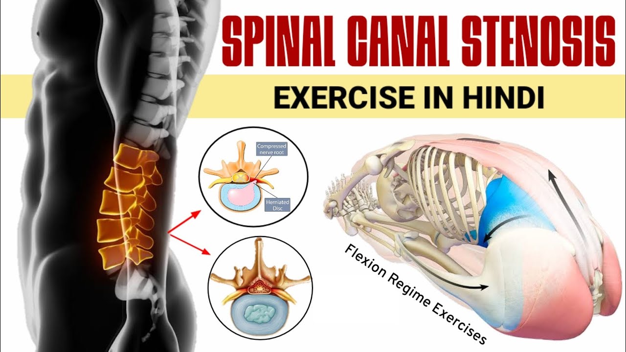 Spinal canal stenosis exercises in hindi - 6 best lumbar canal stenosis exercises in hindi