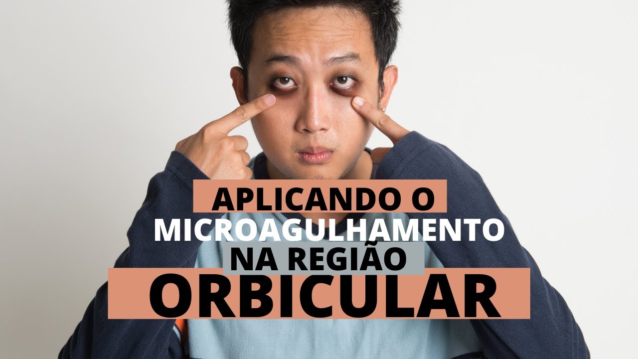 OLHEIRAS - MICROAGULHAMENTO NA REGIÃO ORBICULAR