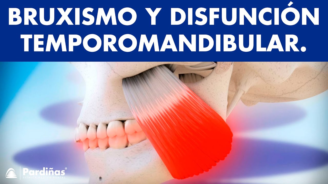 Cómo TRATAR EL BRUXISMO y cuándo usar la FÉRULA DE DESCARGA ©
