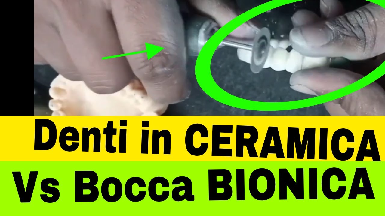 Denti In Metallo e Ceramica Vs in Sistema Bocca bionica del Dr Palmas