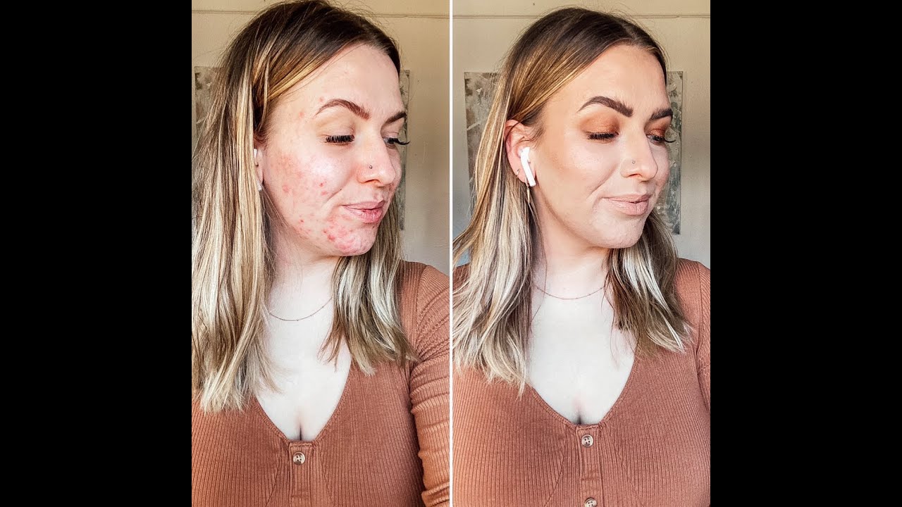 How I cover my hormonal acne with my iiid foundation // SEINT BEAUTY