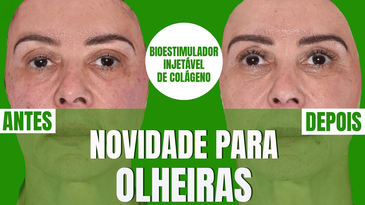 NOVIDADE PARA OLHEIRAS: BIOESTIMULADOR INJETÁVEL