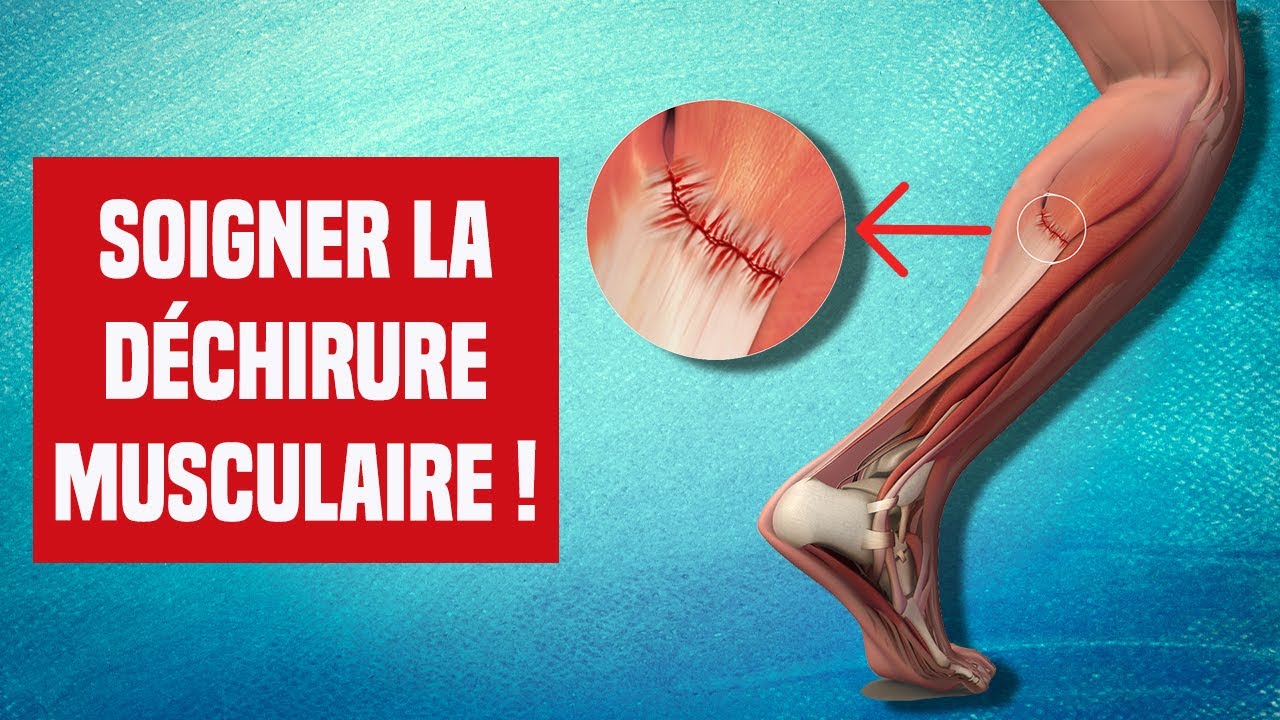 SOIGNER UNE DÉCHIRURE MUSCULAIRE : EXPLICATION ET TRAITEMENT