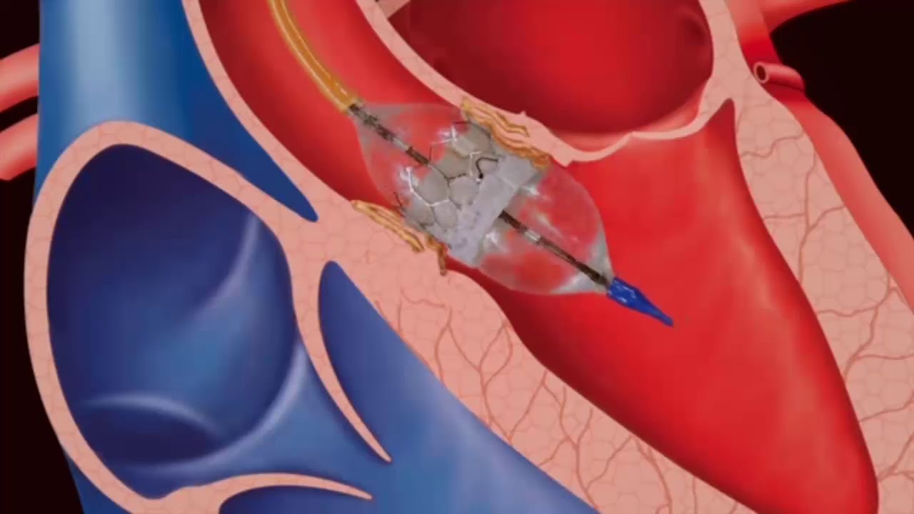 Landmark TAVI TAVR Procedure by Dr. Keyur Parikh, Dr. Dhiren Shah at CIMS Hospital by Cardiac Team