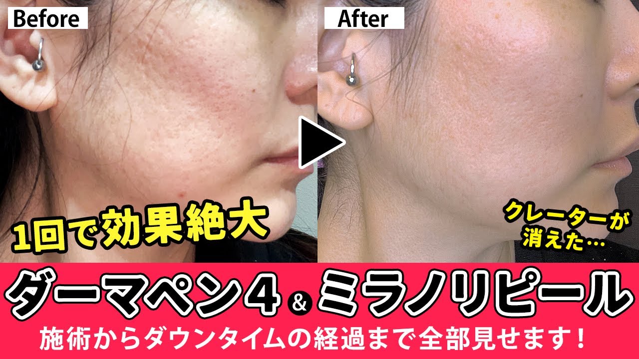【ダーマペン】1回でクレーターが劇的に改善！マジで凸凹消えました…【ミラノリピール】