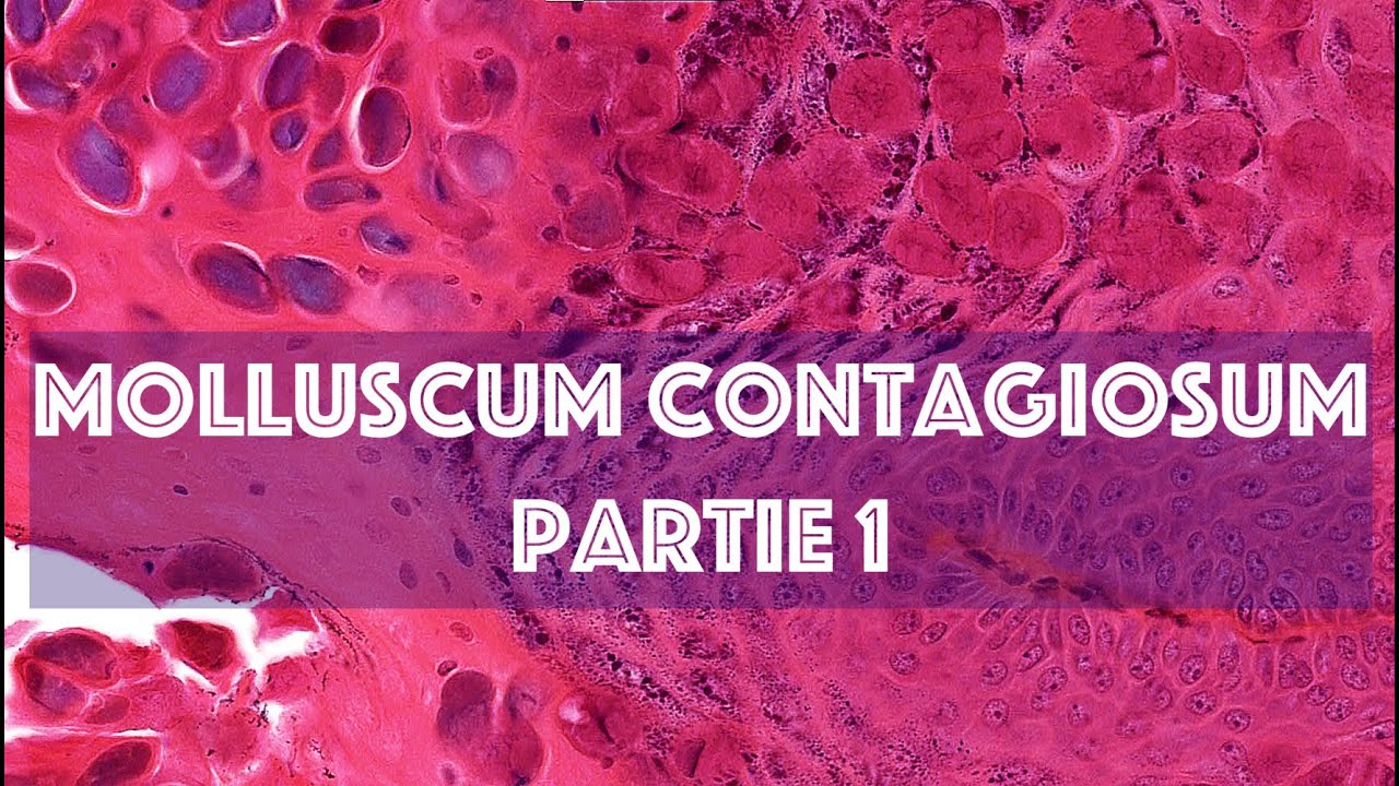 LE MOLLUSCUM CONTAGIOSUM (partie 1) - PATHOLOGIE